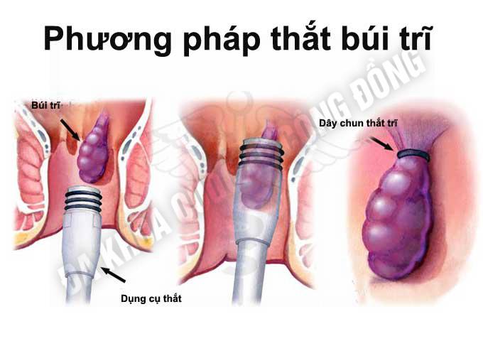 that bui tri khong gay dau